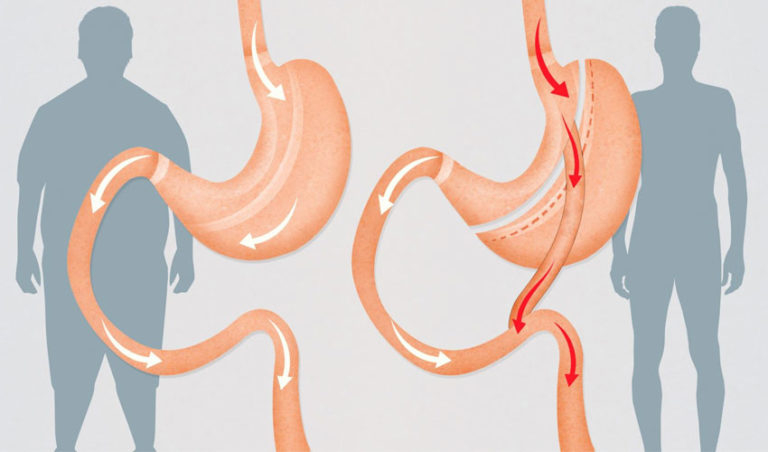 gastric-bypass